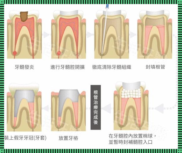 儿童杀神经补牙全攻略：守护宝宝的微笑