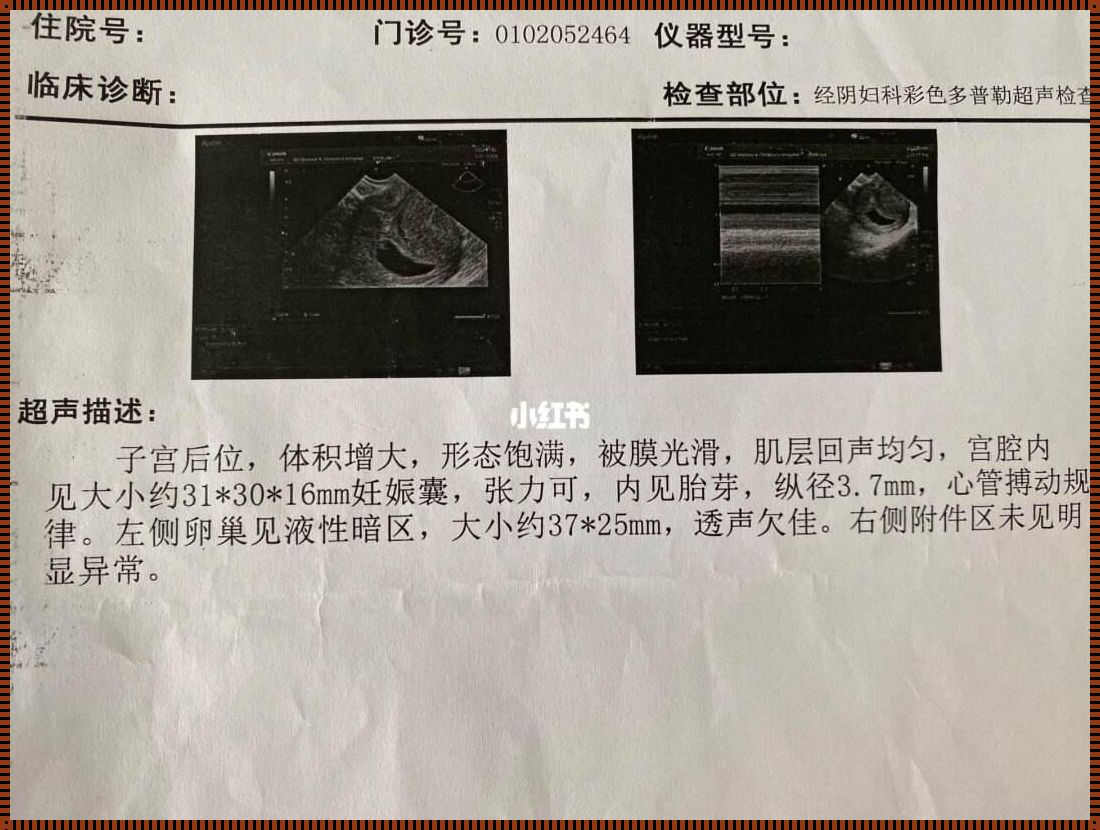 孕期惊喜：12 周突变双胎，奥秘何在？