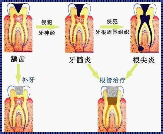 牙周炎治疗：一场持久的战斗